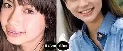 正畸吃瓜,揭秘牙齿矫正背后的那些吃瓜故事